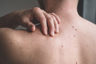 close view of a person scratching their back because they have an itchy mole